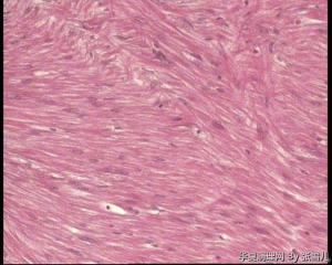请老师看看，直肠息肉，报平滑肌瘤，还是间质瘤图6