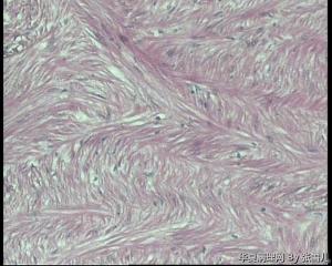 请老师看看，直肠息肉，报平滑肌瘤，还是间质瘤图10