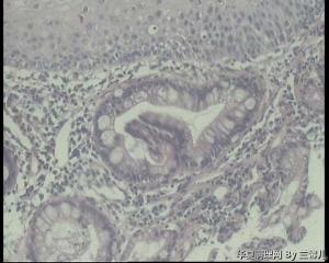 请老师看看，反流性食管炎，腺体也报肠化吗？图6