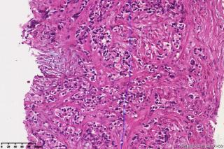 前列腺腺泡腺癌，GLeason4+5?图11