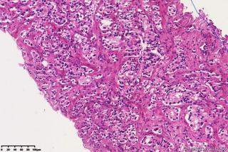 前列腺腺泡腺癌，GLeason4+5?图8