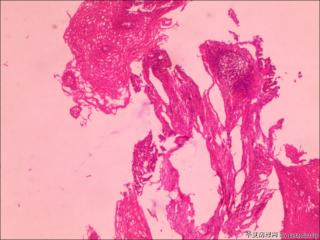 仅见少量异型细胞团，如何诊断图1