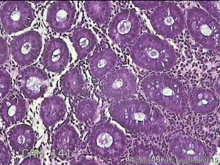 乙状结肠粘膜图14