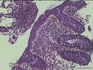 乙状结肠粘膜图19