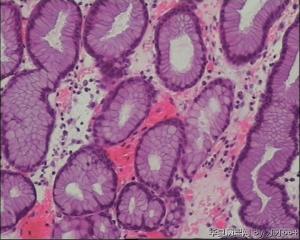 胃镜活检，各位老师请帮忙看看，谢谢！图18
