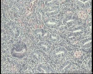 胃粘膜活检，个别腺体轻度非典型增生吗？图10