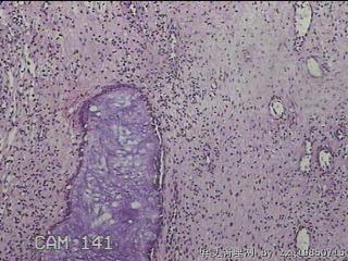 双侧鼻腔新生物图22