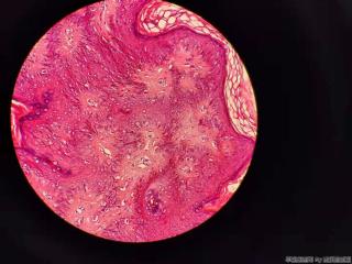 表皮样囊肿，被覆鳞状上皮增生图8