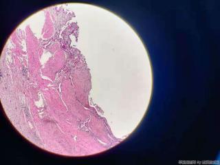 胆囊 腺体不规则，结构异型，细胞尚可图18