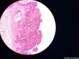 表皮样囊肿，被覆鳞状上皮增生图7