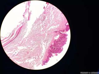 表皮样囊肿，被覆鳞状上皮增生图1