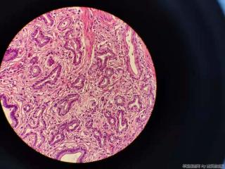 胆囊 腺体不规则，结构异型，细胞尚可图9