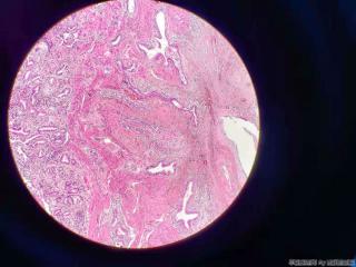 胆囊 腺体不规则，结构异型，细胞尚可图8