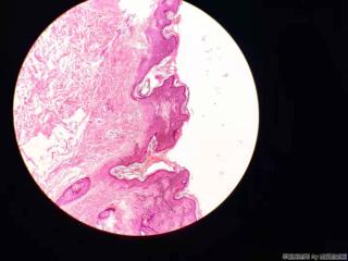表皮样囊肿，被覆鳞状上皮增生图3