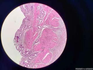 胆囊 腺体不规则，结构异型，细胞尚可图3