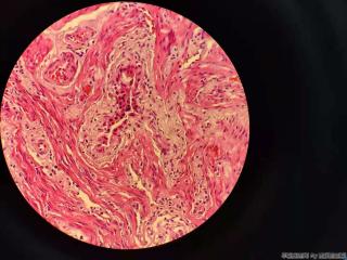 胆囊 腺体不规则，结构异型，细胞尚可图7