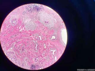 胆囊 腺体不规则，结构异型，细胞尚可图6