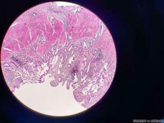 胆囊 腺体不规则，结构异型，细胞尚可图17