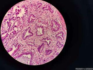 胆囊 腺体不规则，结构异型，细胞尚可图4