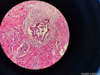 胆囊 腺体不规则，结构异型，细胞尚可图1