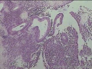宫腔内组织图11