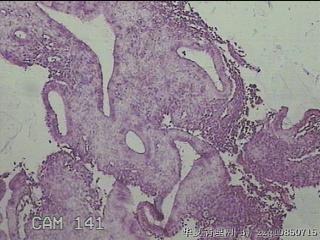宫腔内组织图18