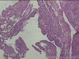 宫腔内组织图16