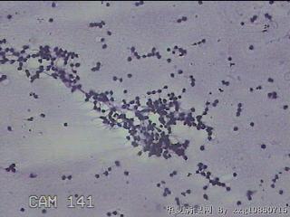 膝关节腔积液7ml图4