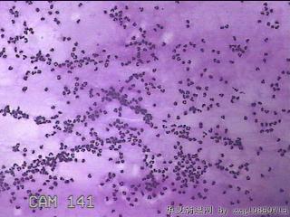 膝关节腔积液7ml图24