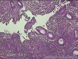 宫腔内膜图13