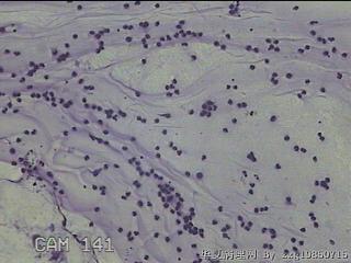 膝关节腔积液7ml图6