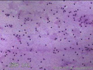 膝关节腔积液7ml图23