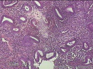 宫腔内膜图12