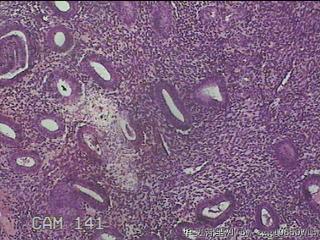 宫腔内膜图17