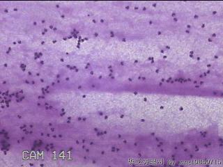 膝关节腔积液7ml图18