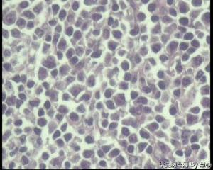 请老师看看，右侧腋窝淋巴结，小B细胞淋巴瘤吗？图8