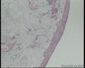 请老师看看化脓性阑尾炎术中腹腔游离体怎么报？图3