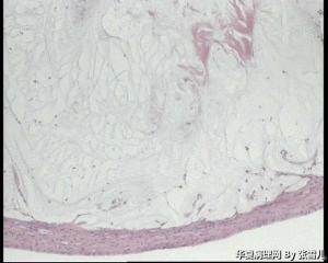 请老师看看化脓性阑尾炎术中腹腔游离体怎么报？图1