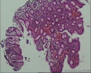 胃体活检，请帮忙看看，谢谢！图10