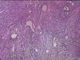 子宫粘膜下肌瘤图7