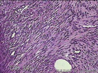 子宫粘膜下肌瘤图26