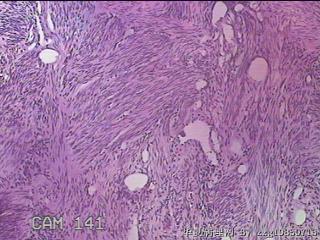 子宫粘膜下肌瘤图9