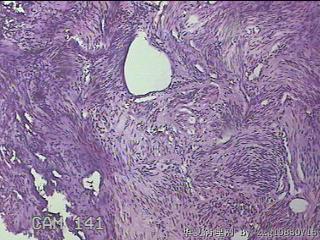 子宫粘膜下肌瘤图10