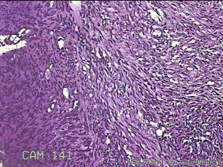 子宫粘膜下肌瘤图27