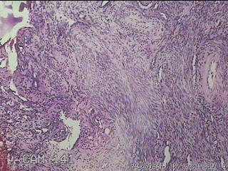 子宫粘膜下肌瘤图15