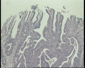 乙状结肠活检，高级别，不够癌吧？图7