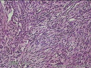 子宫粘膜下肌瘤图30