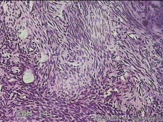 子宫粘膜下肌瘤图29
