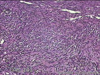子宫粘膜下肌瘤图20