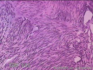 子宫粘膜下肌瘤图32